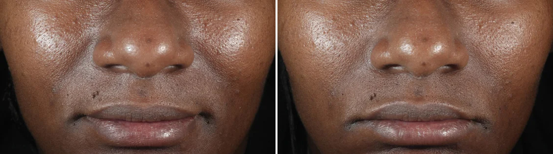 DiamondGlow® Before/After 15 minutes post treatment