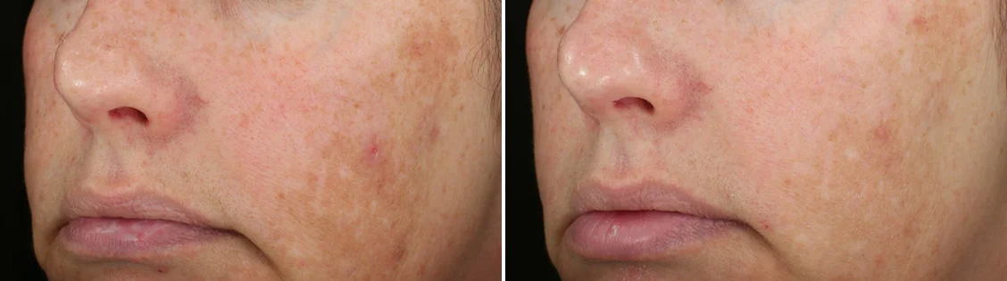 DiamondGlow® Before/After 3 treatments