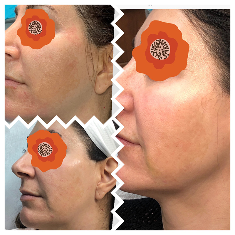 Before & After - PRP Microneedling